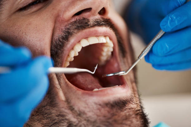 Best Emergency Wisdom Tooth Extraction in Lake Tapps, WA